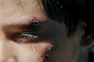 injury